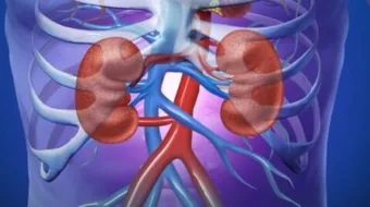 حصوة الكلى وأعراضها