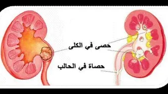 حصى الكلى أسبابها وعلاجها