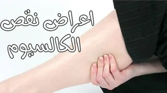 نقص الكالسيوم