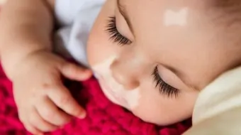 نقص صبغة الجلد عند الأطفال