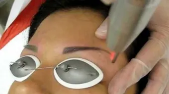 إزالة تاتو الحواجب بالليزر