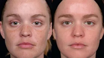 تقشير البشرة بالليزر