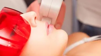 الليزر لإزالة الشعر الزائد