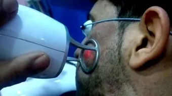 علاج آثار حب الشباب بالليزر