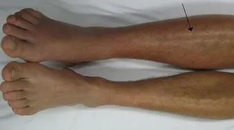 تخثر الدم في الساق