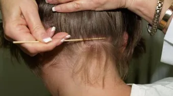 القمل وكيفية القضاء عليه