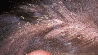 أضرار القمل على الشعر