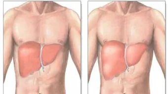 تضخم الكبد وأسبابه