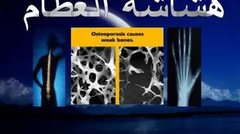بحث عن هشاشة العظام