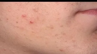 وسائل لإزالة آثار حب الشباب للبشرة الدهنية