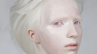 نقص صبغة الميلانين