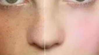 طرق إزالة الكلف