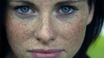 علاج الكلف - فيديو