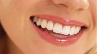 طريقة لتبييض الأسنان