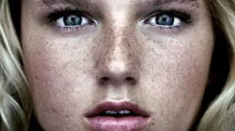 طرق إزالة النمش