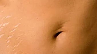 طرق إزالة علامات تمدد الجلد