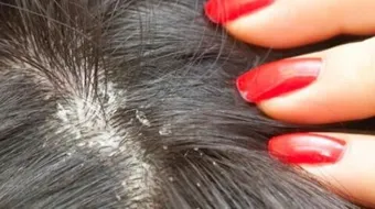 طرق علاج القمل والصيبان