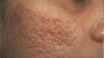 طرق علاج آثار حب الشباب