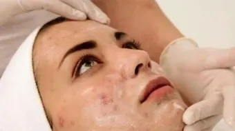 خلطات للتخلص من حب الشباب نهائياً