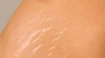 خلطات للتخلص من السيلوليت