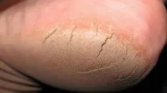 خلطة لإزالة تشققات القدمين