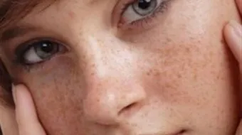 خلطة لإزالة النمش