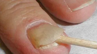 فطريات الأظافر