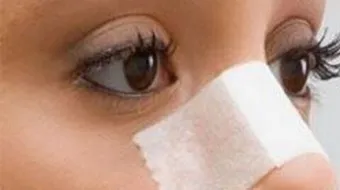 عملية تعديل الحاجز الانفي