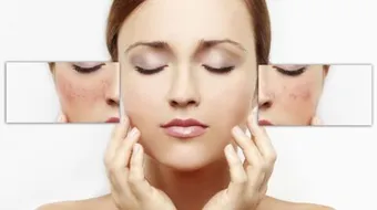 وصفات طبيعية لإزالة البقع السوداء