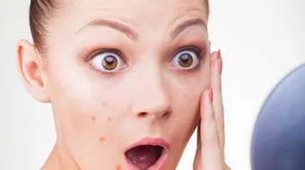 طرق طبيعية للتخلص من حب الشباب وآثاره