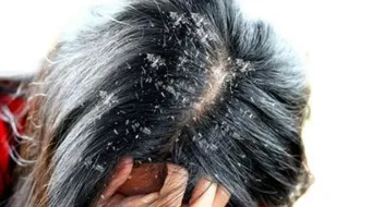 طرق طبيعية للتخلص من قشرة الشعر