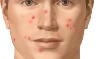 طرق طبيعية لإزالة حب الشباب