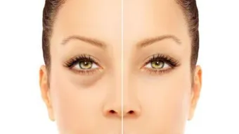 طرق طبيعية لإزالة الهالات السوداء