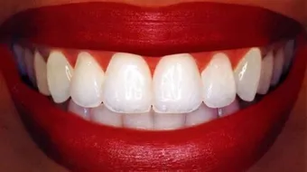 طرق طبيعية لتبييض الأسنان