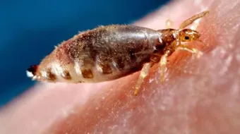 التخلص نهائياً من القمل