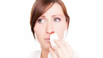 رعاف الأنف عند الحامل