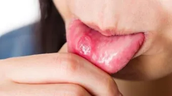 الفطريات بالفم عند الأطفال