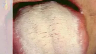 فطريات الفم عند الأطفال