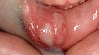 فطريات الفم عند الأطفال الرضع