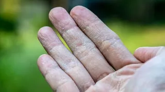 تقشر جلد الأصابع