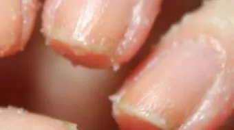 تقشر الجلد حول الأظافر