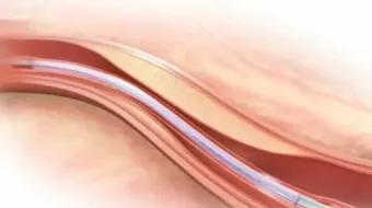 مرض الشرايين المحيطية