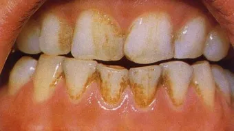 حلول لتصبغات الأسنان