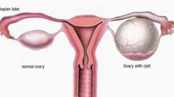 تكيس أم أكياس المبايض