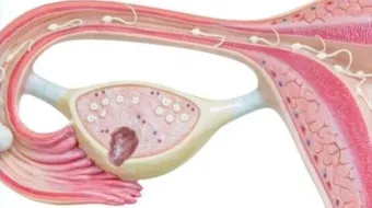 تكيس المبايض وتأخر حدوث الحمل