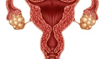 تكيس المبايض وتأخر الحمل