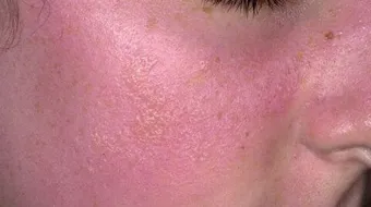 علاج ما بعد الحروق