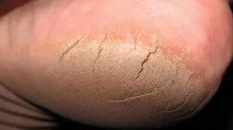 وصفة لعلاج تشقق الكعبين