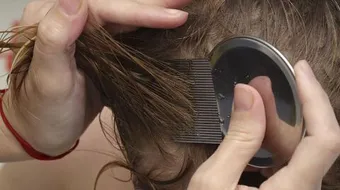 وصفة لعلاج القمل