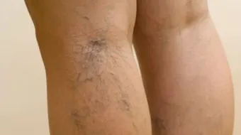 وصفة لعلاج الدوالي